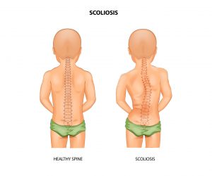 SCOLIOR脊椎側彎矯正護具;脊柱矯具;脊柱側彎矯正背架